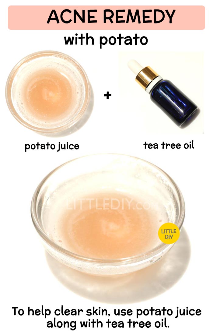 Potato to treat acne -