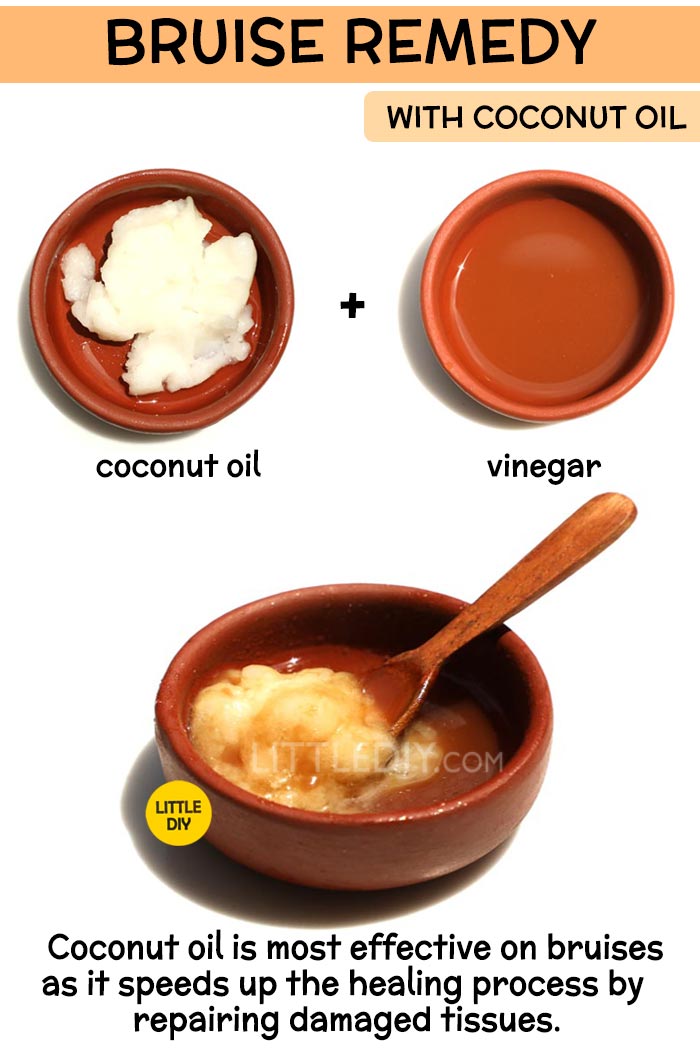 Coconut Oil bruise Remedy -