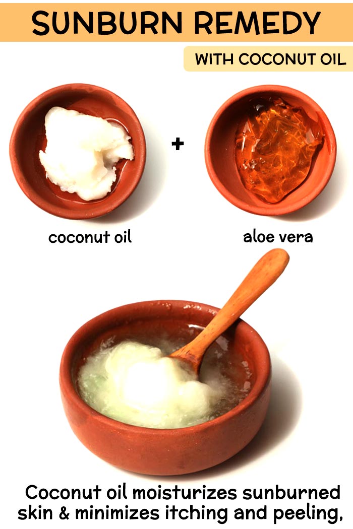 Coconut Oil Sunburn Remedy -