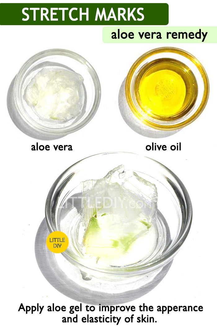 Aloe vera for Stretch marks -