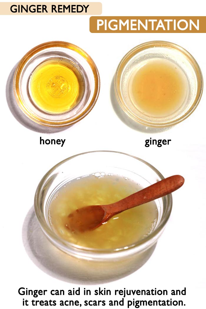 Ginger for pigmentation and acne -