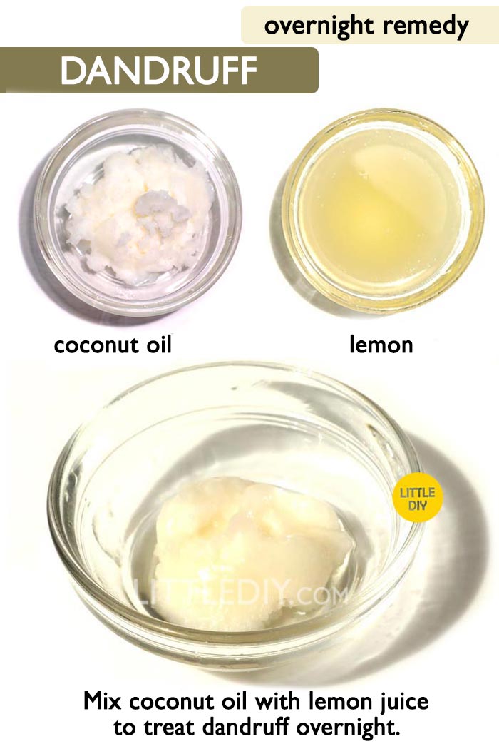 Get rid of dandruff overnight -